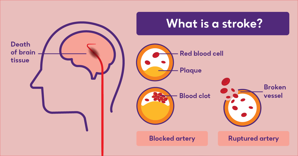 Illustration of what a stroke is in the brain.